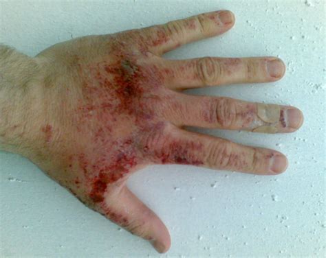 Chemical Burns