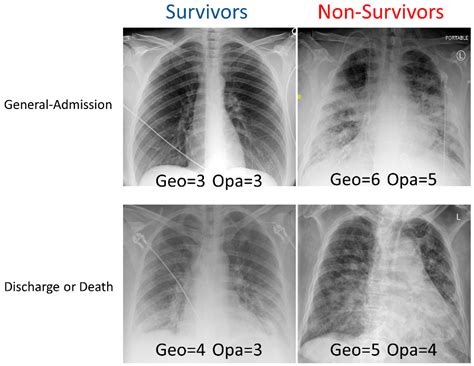 Chest X-Ray Limitations Image