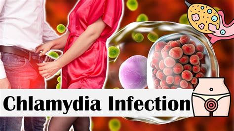 Chlamydia Infection