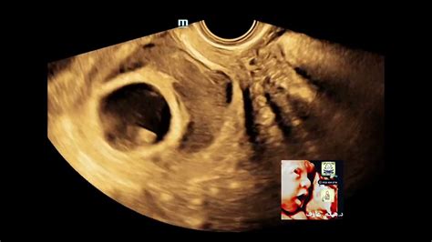 Chorionic Hematoma