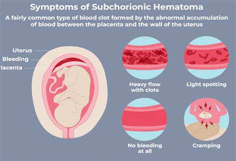 Chorionic Hematoma Bleeding