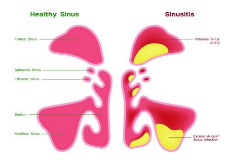 Chronic Sinus Infection Treatment Options