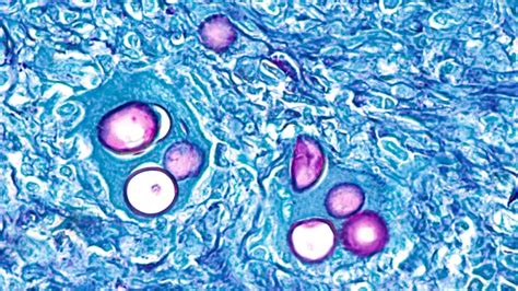 Coccidioidomycosis