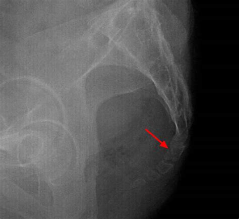 Coccyx Fracture