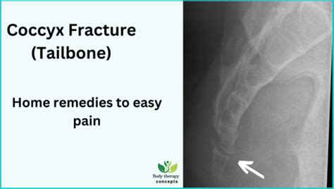 Coccyx Recovery