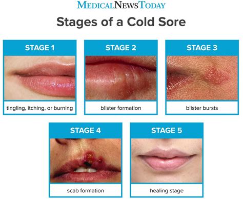 Cold Sore Research and Development