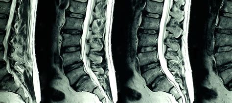 Common Conditions Diagnosed with MRI of Lumbar Spine