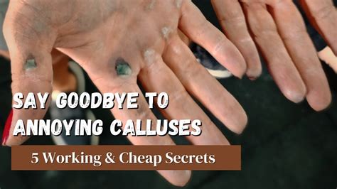 Common Mistakes in Callus Removal