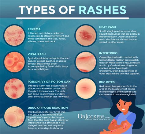 Common Rashes