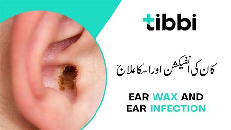 Complications of Earwax