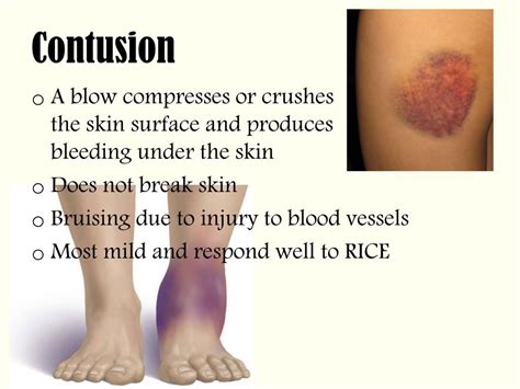 Complications of Contusions