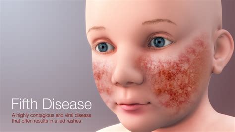 Complications of Fifth Disease