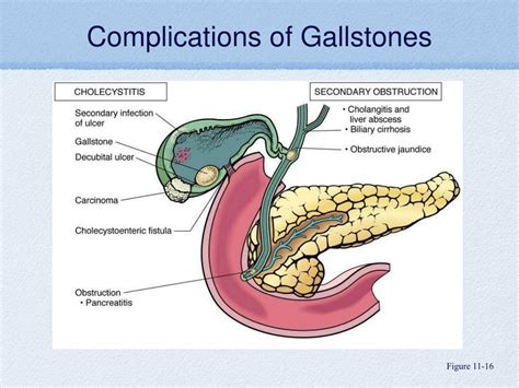 Complications of Gallstones