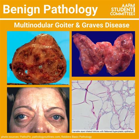 Complications of Goiter