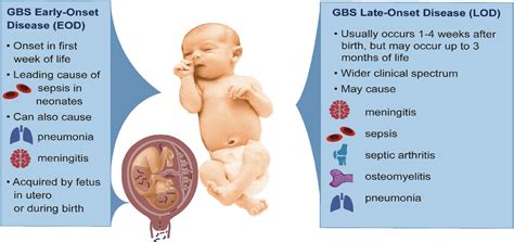 Complications of Group B Streptococcus