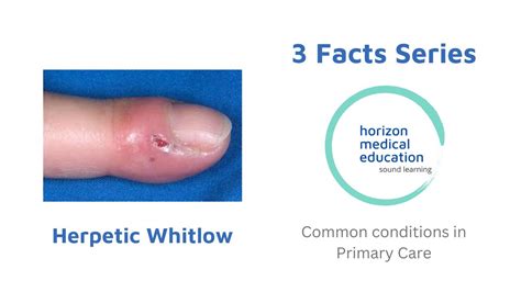 Complications of Herpes on Finger