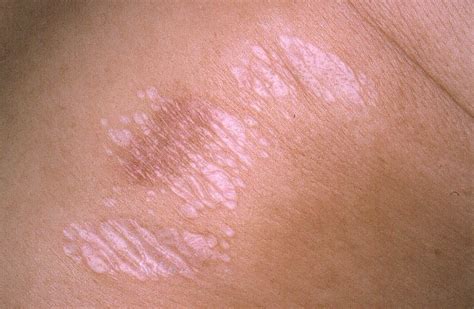 Complications of Lichen Sclerosus
