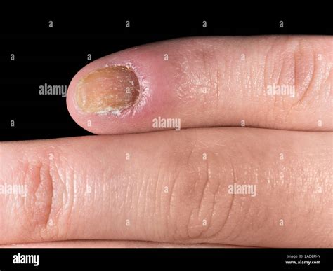 Complications of Swollen Finger Around Nail
