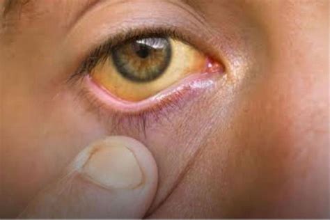 Complications of Yellow Skin and Eyes