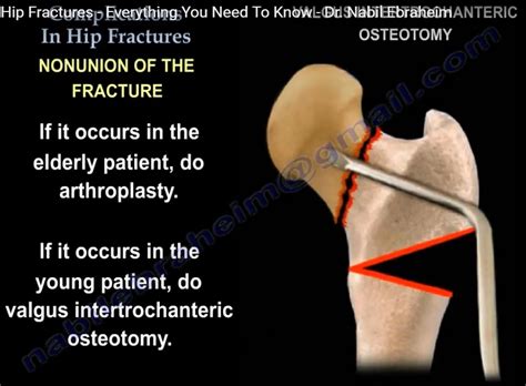Complications of a Broken Hip