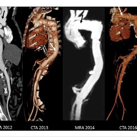 Computed Tomography Angiography Scan