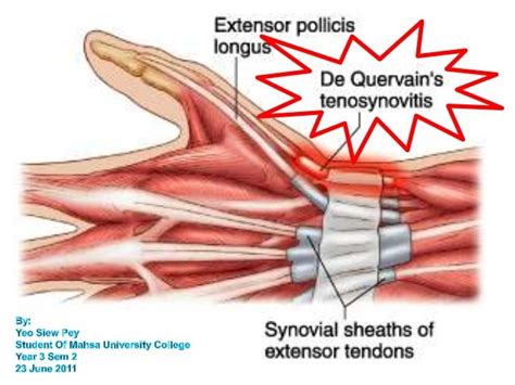 Conclusion and Final Thoughts on De Quervain's Disease