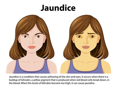 Coping with Jaundice