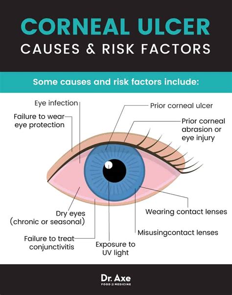 Corneal Ulcer Symptoms