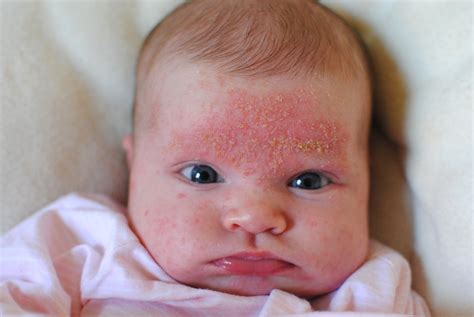 Cradle Cap On Face Causes