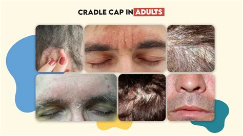 Cradle Cap in Adults