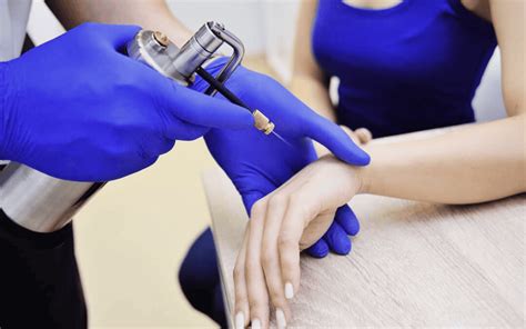 Cryotherapy For Warts Removal