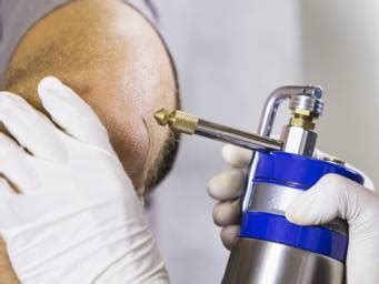 Cryotherapy For Warts Removal What To Expect