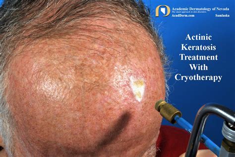 Cryotherapy for Keratosis