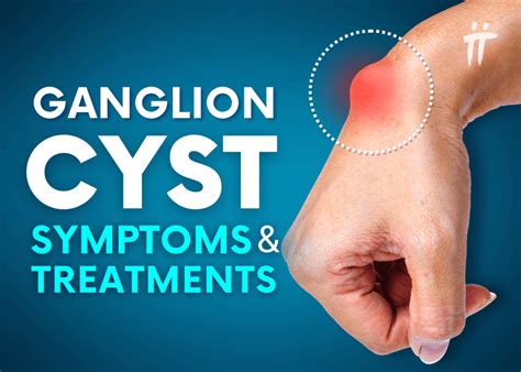 Cysts Treatment