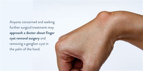 Cysts Treatment Options