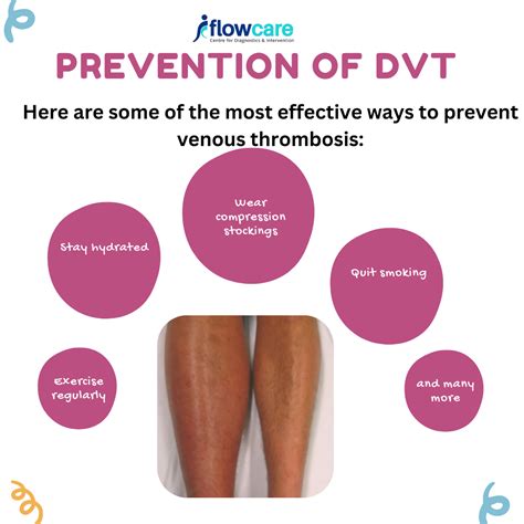DVT Prevention