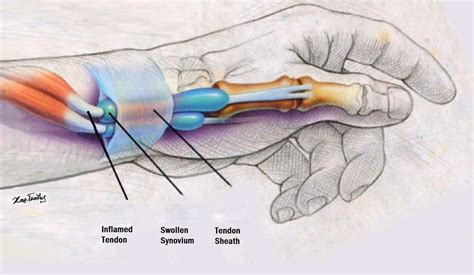De Quervain's Tenosynovitis