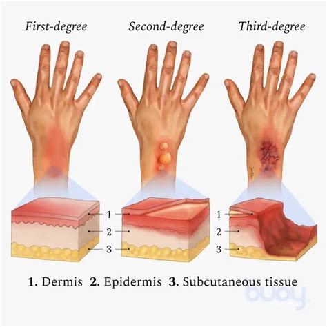 Degree Of Burns Classification