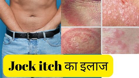 Dhobi Itch Complications and Risks