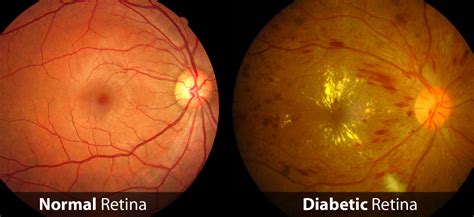 Diabetic Retinopathy