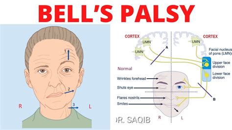 Diagnosing Bells Palsy