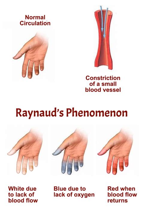 Diagnosing Raynaud's Disease