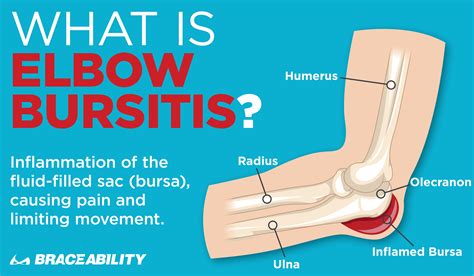 Diagnosis of Elbow Bursitis