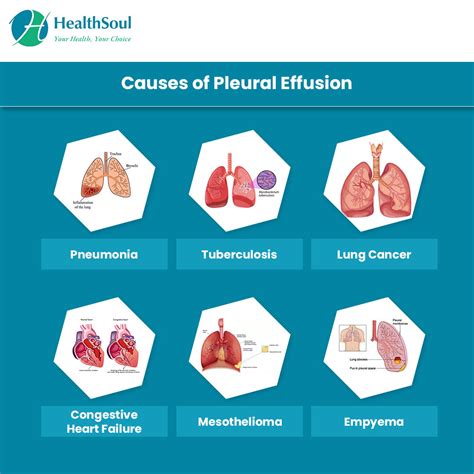Diagnosis and Treatment of Pleural Effusion