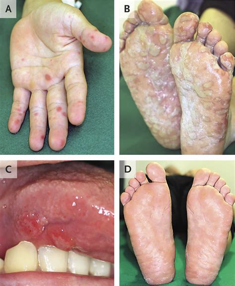 Diagnosis of Hand Foot Mouth Disease