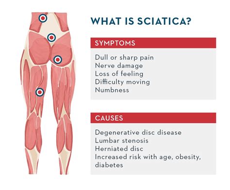 Difficulty Walking or Standing as a Sciatica Symptom