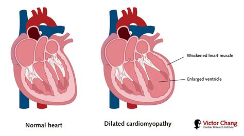 Dilated Cardiomyopathy