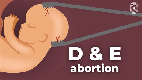 Dilation and Evacuation Abortion