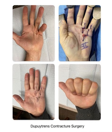 Dupuytren's contracture surgery