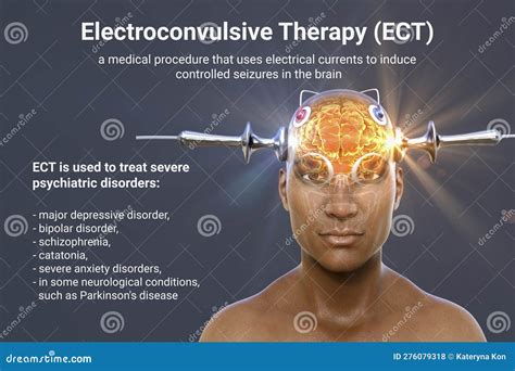 ECT Medical Treatment Options
